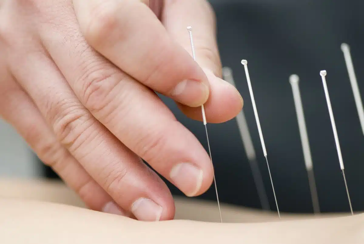 Comment se former à l'acupuncture